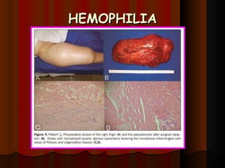 HEMOPHILIA 