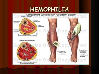 HEMOPHILIA 