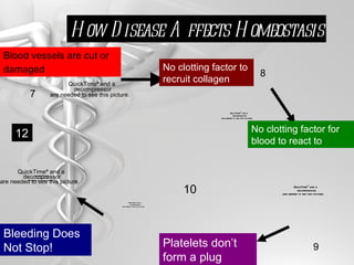 How It Normally Works Blood vessels are cut or damaged   Clotting factor recruits collagen http://www.3dchem.com/molecules.asp?ID=195 8 7 Blood reacts to clotting factors Platelets form plug at the injury site Bleeding stops!! 11 10 9 How Disease Affects Homeostasis No clotting factor to recruit collagen No clotting factor for blood to react to Platelets don’t form a plug Bleeding Does Not Stop! 12 