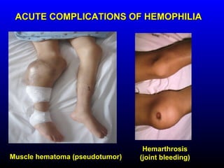 ACUTE COMPLICATIONS OF HEMOPHILIA




                                 Hemarthrosis
Muscle hematoma (pseudotumor)   (joint bleeding)
 