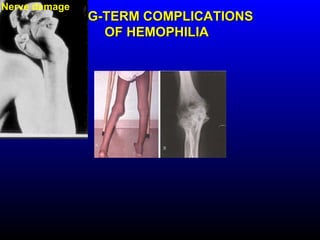 Nerve destruction
Joint damage
            LONG-TERM COMPLICATIONS
                 OF HEMOPHILIA
 