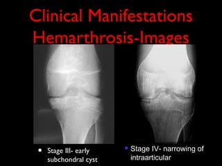 Clinical Manifestations
Hemarthrosis-Images




 •   Stage III- early      Stage IV- narrowing of
                            intraarticular space
     subchondral cyst
 