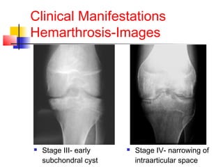 Clinical Manifestations
Hemarthrosis-Images
 Stage III- early
subchondral cyst
 Stage IV- narrowing of
intraarticular space
 