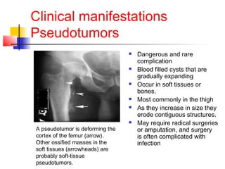 Clinical manifestations
Pseudotumors
 Dangerous and rare
complication
 Blood filled cysts that are
gradually expanding
 Occur in soft tissues or
bones.
 Most commonly in the thigh
 As they increase in size they
erode contiguous structures.
 May require radical surgeries
or amputation, and surgery
is often complicated with
infection
A pseudotumor is deforming the
cortex of the femur (arrow).
Other ossified masses in the
soft tissues (arrowheads) are
probably soft-tissue
pseudotumors.
 