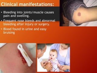 Clinical manifestations:
• Bleeding into joints/muscle causes
pain and swelling.
• Frequent nose bleeds and abnormal
bleeding after injury or surgery.
• Blood found in urine and easy
bruising
 