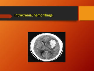 Intracranial hemorrhage
 