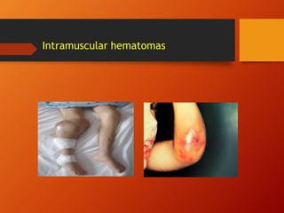 Intramuscular hematomas
 