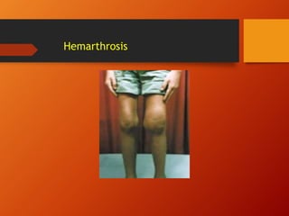 Hemarthrosis
 
