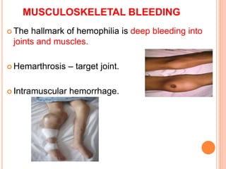 Hemophilia and ITP | PPTX
