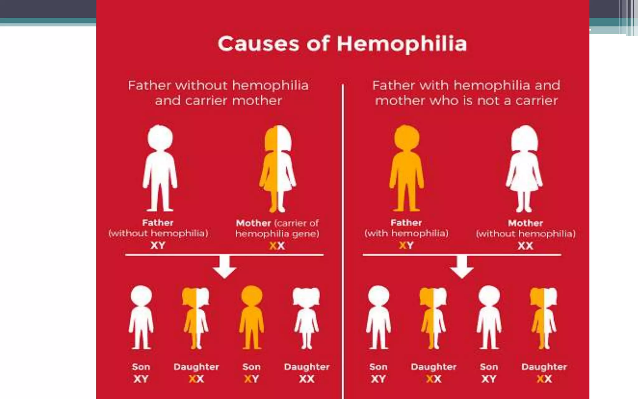 HEMOPHILIA IN CHILDREN | PPTX
