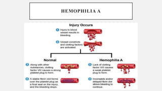 HEMOPHILIA A
 
