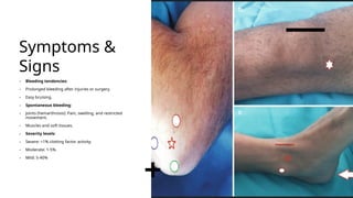 Symptoms &
Signs
– Bleeding tendencies:
– Prolonged bleeding after injuries or surgery.
– Easy bruising.
– Spontaneous bleeding:
– Joints (hemarthrosis): Pain, swelling, and restricted
movement.
– Muscles and soft tissues.
– Severity levels:
– Severe: <1% clotting factor activity.
– Moderate: 1-5%.
– Mild: 5-40%
 