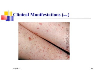 Clinical Manifestations (cont.)
11/19/17 43
 