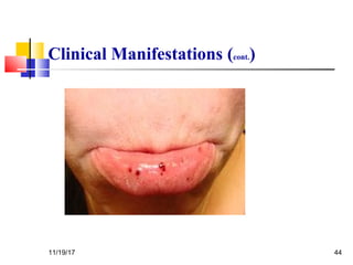 Clinical Manifestations (cont.)
11/19/17 44
 