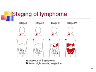 Stage I Stage II Stage III Stage IV
Staging of lymphoma
A: absence of B symptoms
B: fever, night sweats, weight loss
67
 
