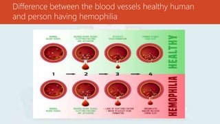 Hemophilia | PPTX