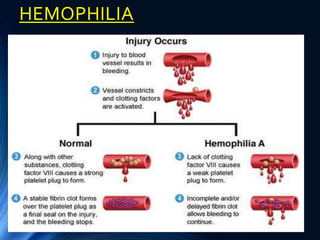 Hemophilia | PPTX