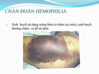 CHẨN ĐOÁN HEMOPHILIA
Đặc điểm lâm sàng:
1. Xuất huyết da dạng mảng bầm có nhân (tụ máu), xuất huyết
thƣờng chậm và dễ tái phát .
 