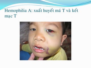 Hemophilia A: xuaát huyeát maù T vaø keát
maïc T
 