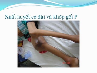 Xuaát huyeát cô ñuøi vaø khôùp goái P
 