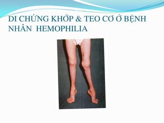DI CHỨNG KHỚP & TEO CƠ Ở BỆNH
NHÂN HEMOPHILIA
 