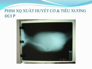 PHIM XQ XUẤT HUYẾT CƠ & TIÊU XƢƠNG
ĐÙI P
 