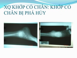 XQ KHỚP CỔ CHÂN: KHỚP CỔ
CHÂN BỊ PHÁ HỦY
 