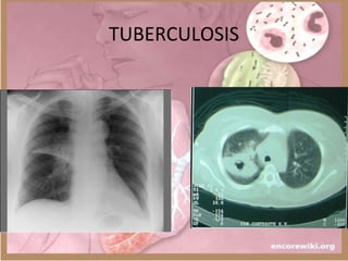 TUBERCULOSIS
 