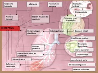 Necrosis
tumoral
Carcinoma
bronquial
Erosión de vasos de
cavidades
adenoma Tuberculosis
pulmonar
Bronquitis
crónica
Bronquiectasia
Rotura de vasos
bronquiales
HEMOPTISIS
Hemorragia por
diapédesis
Estasis pulmonar Estenosis mitral
Insuficiencia cardiaca
Neumonías
bacterianas
Infarto pulmonar
Traumatismos
Aneurisma de aorta
Discrasias sanguíneas
Defectos vasculares
Necrosis
pulmonar
Laceración de vasos del
parénquima
Rotura de aorta
Defectos de
hemostasis
 