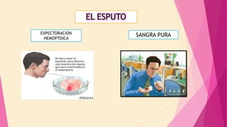 EL ESPUTO
EXPECTORACION
HEMOPTOICA
SANGRA PURA
 