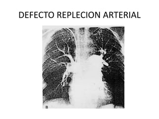 DEFECTO REPLECION ARTERIAL
 