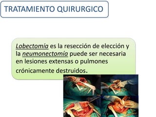 TRATAMIENTO QUIRURGICO
Lobectomía es la resección de elección y
la neumonectomía puede ser necesaria
en lesiones extensas o pulmones
crónicamente destruidos.
 