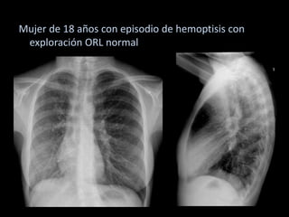 Mujer de 18 años con episodio de hemoptisis con
exploración ORL normal
 