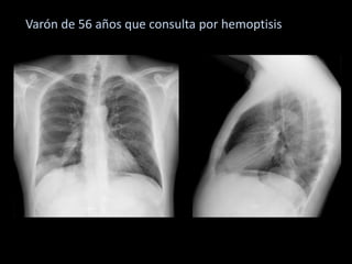 • Otro caso
Varón de 56 años que consulta por hemoptisis
 