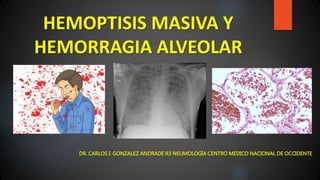 HEMOPTISIS MASIVA Y
HEMORRAGIA ALVEOLAR
DR. CARLOS I. GONZALEZ ANDRADE R3 NEUMOLOGÍA CENTRO MEDICO NACIONAL DE OCCIDENTE
 
