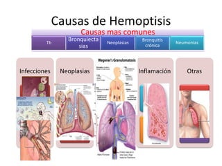 Causas de Hemoptisis
Infecciones
Parénquima
pulmonar
TB
Árbol
traqueobronquial
Neoplasias
Benignas/Malignas
Primarias: Ca
Pulmón
Metástasis
Vasculares
Vasculitis
Tromboembolismo
Inflamación
Bronquiolitis
Bronquiectasias
Otras
Anomalías
congénitas
Cuerpo extraño
Traumatismo
Causas mas comunes
Tb
Bronquiecta
sias
Neoplasias
Bronquitis
crónica
Neumonías
 