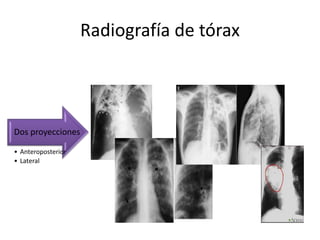Radiografía de tórax
• Anteroposterior
• Lateral
Dos proyecciones
 