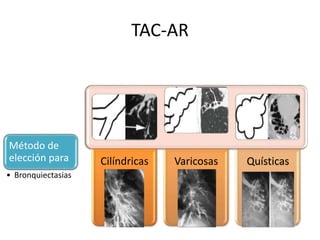 TAC-AR
Método de
elección para
• Bronquiectasias
Cilíndricas Varicosas Quísticas
 
