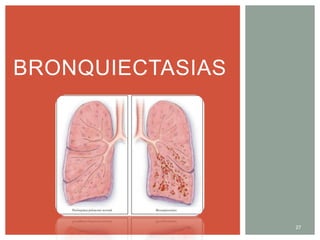 BRONQUIECTASIAS
27
 