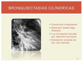  Contornos irregulares
 Diámetro distal algo
dilatado
 Luz bronquial ocluida
por tapones mucosos
 Dilatación aislada de
las vías aéreas
BRONQUIECTASIAS CILÍNDRICAS
36
 