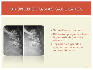 Sacos llenos de mocos
 Dilatación progresiva hacia
la periferia de las vías
aéreas
 Terminan en grandes
quistes, sacos o como
racimos de uvas
38
BRONQUIECTASIAS SACULARES
 