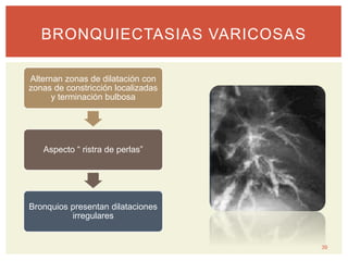 39
BRONQUIECTASIAS VARICOSAS
Alternan zonas de dilatación con
zonas de constricción localizadas
y terminación bulbosa
Aspecto “ ristra de perlas”
Bronquios presentan dilataciones
irregulares
 