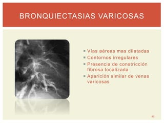  Vías aéreas mas dilatadas
 Contornos irregulares
 Presencia de constricción
fibrosa localizada
 Aparición similar de venas
varicosas
40
BRONQUIECTASIAS VARICOSAS
 
