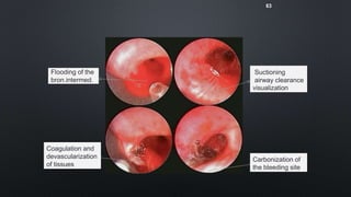 Devascularization Hemoptysis and its management | PPTX