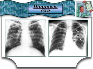 DiagnosisDiagnosis
CXRCXR
 