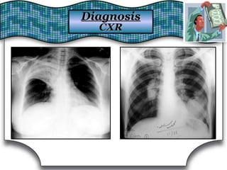 DiagnosisDiagnosis
CXRCXR
 