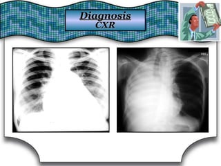 DiagnosisDiagnosis
CXRCXR
 
