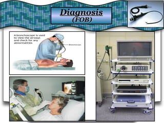DiagnosisDiagnosis
(FOB)(FOB)
 