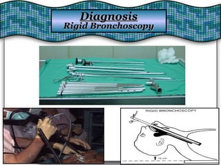DiagnosisDiagnosis
Rigid BronchoscopyRigid Bronchoscopy
 