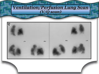 Ventilation/Perfusion Lung ScanVentilation/Perfusion Lung Scan
(V/Q scan)(V/Q scan)
 